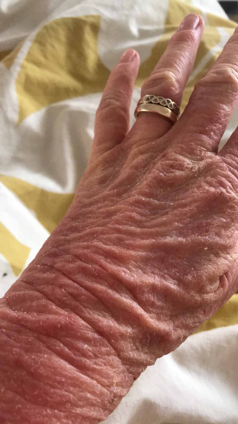 Nicky’s hand looking wrinkled (Collect/PA Real Life).