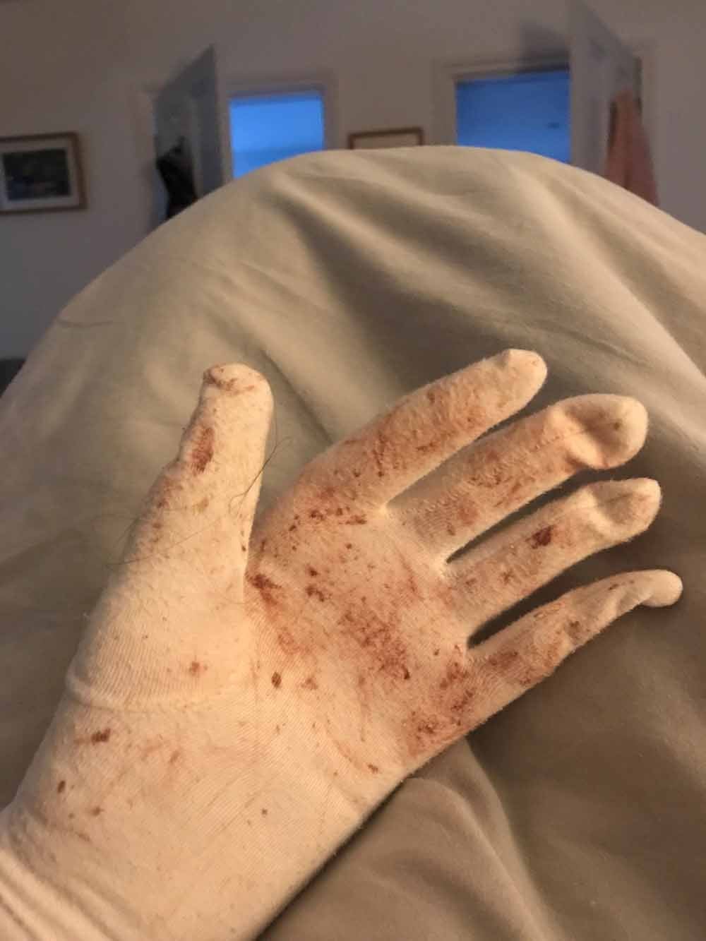 The gloves Nicky wears to bed featuring blood from where she has scratched in the night (Collect/PA Real Life).