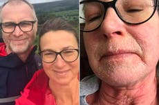 Teacher says her skin ‘sheds like a snake’ after 44-year steroid cream ‘addiction’