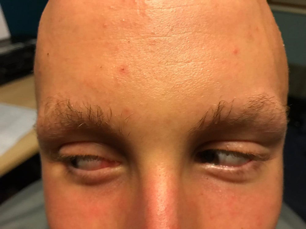 Sam’s hair loss on his natural eyebrows (Collect/PA Real Life)