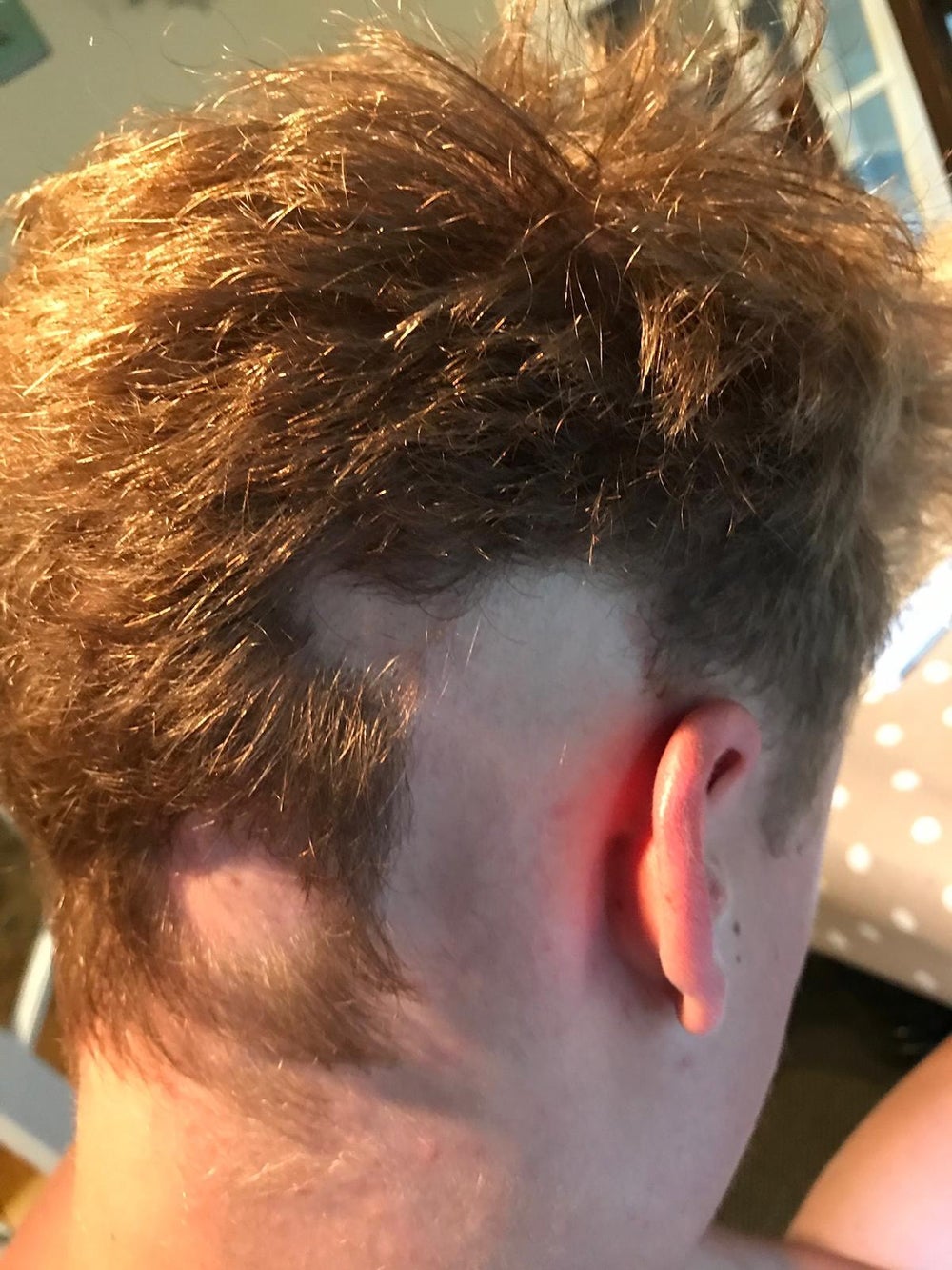 The hair loss on Sam’s head (Collect/PA Real Life)