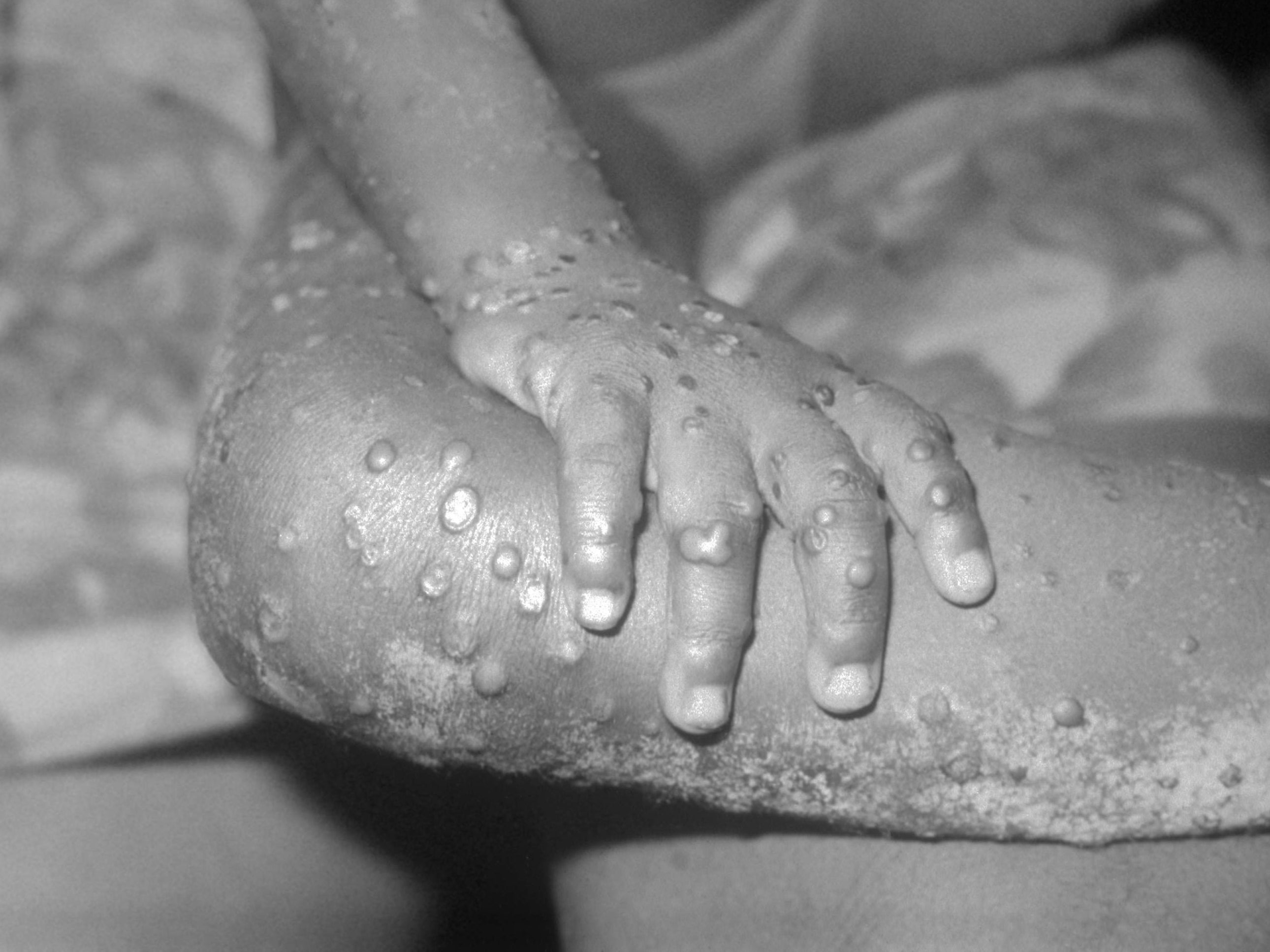 One in ten people infected with monkeypox dies from the rare disease which leaves victims covered in painful blisters and rashes