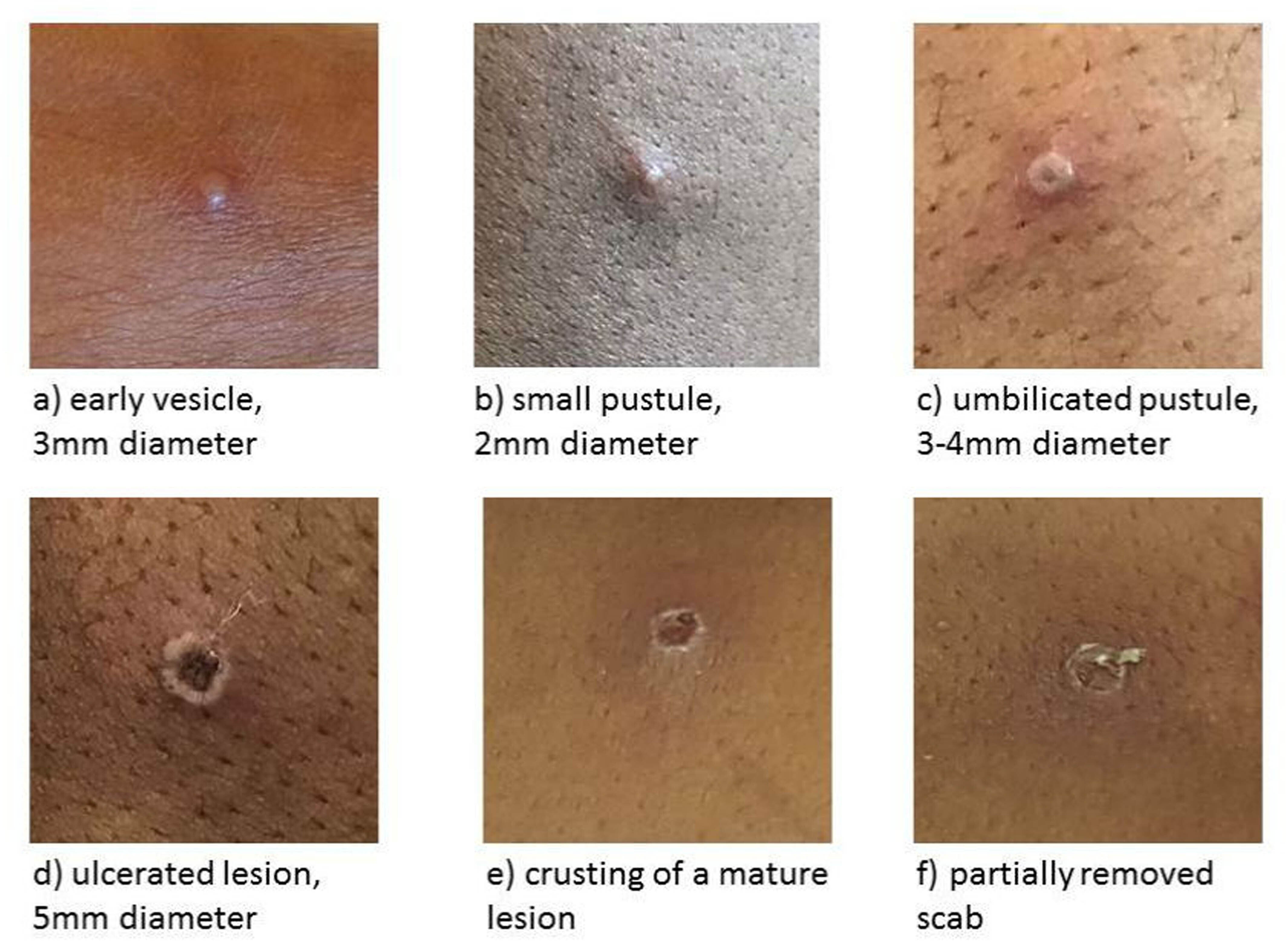 The stages of monkeypox