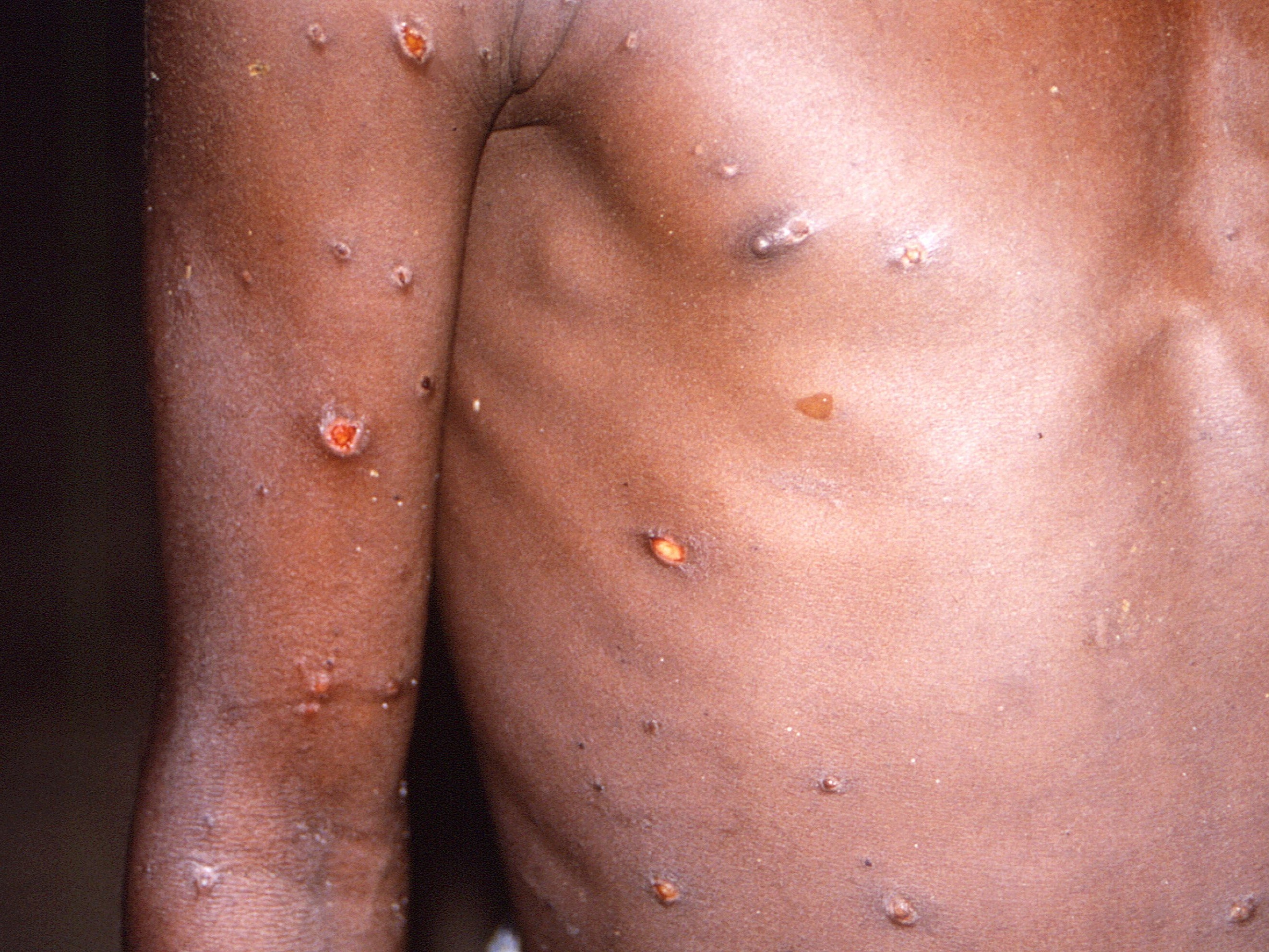 Monkeypox was first detected in the Democratic Republic of the Congo