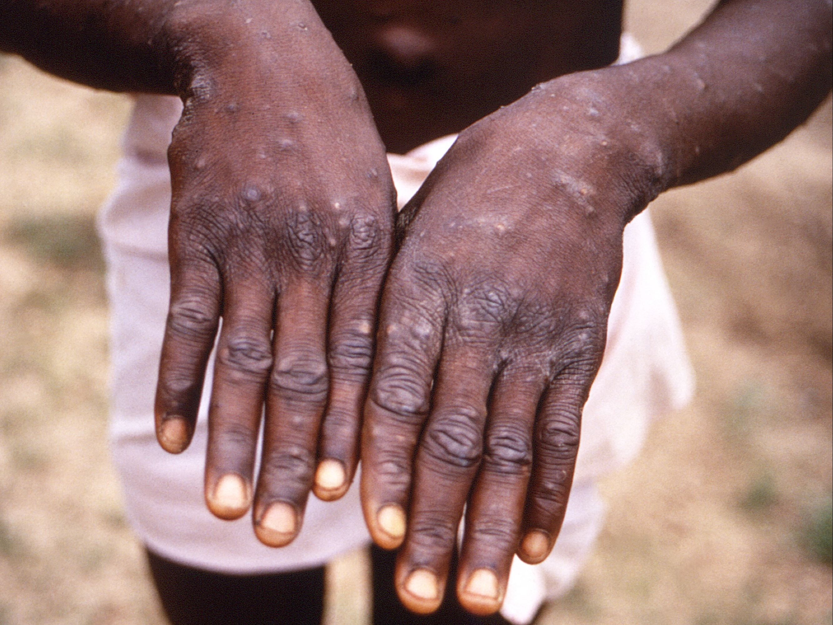 A case of monkeypox