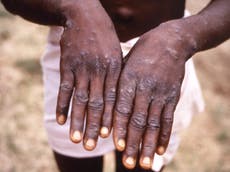 Monkeypox outbreak ‘largest ever’ in Europe as 100 cases identified