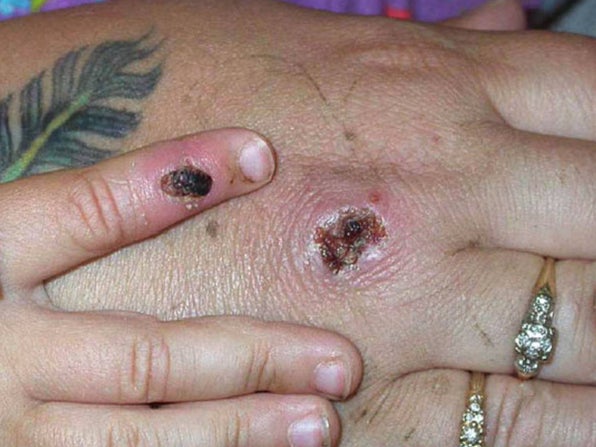 Early symptoms of monkeypox showing on a patient’s hands