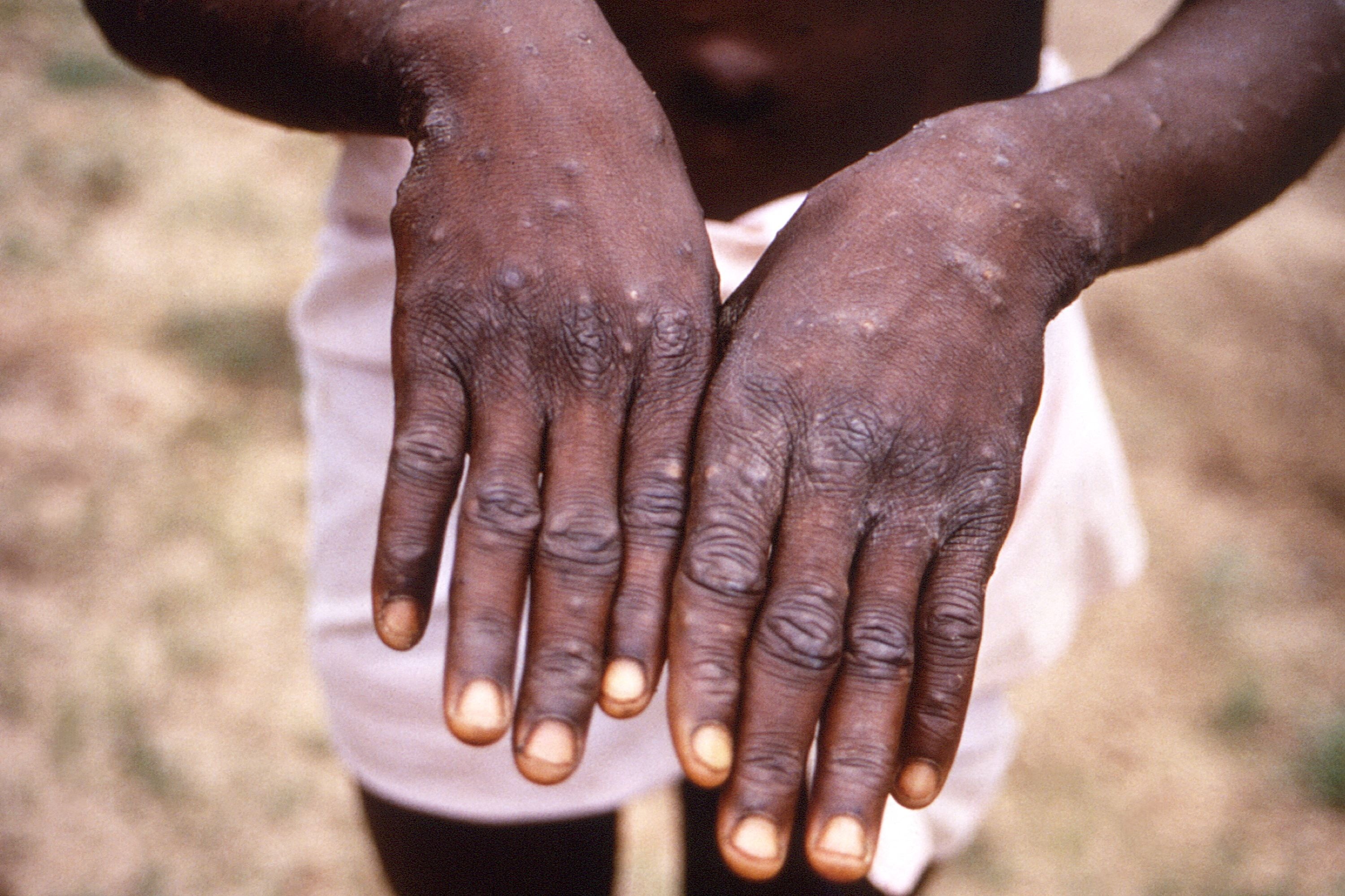 An image from an investigation into an outbreak of monkeypox