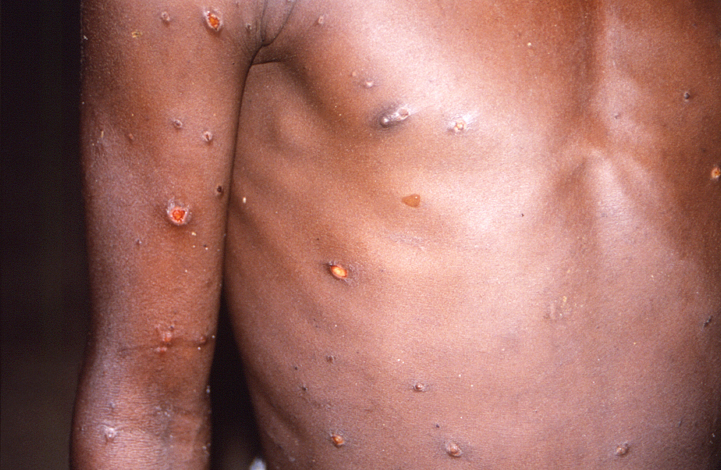 The right arm and torso of a patient with lesions due to monkeypox (CDC/AP)