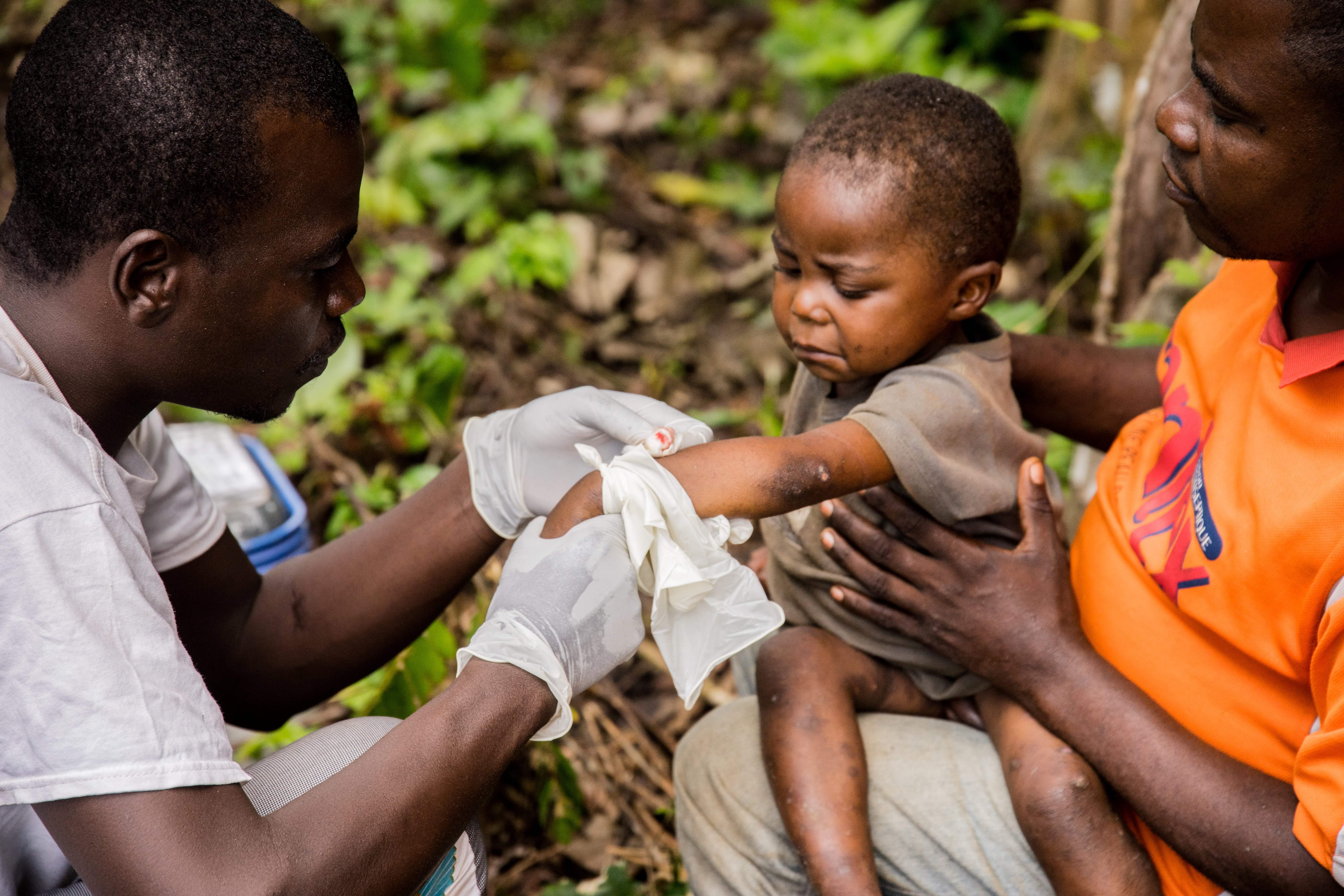 A child affected by monkeypox sits on his father's legs while receiving treatment, during a previous outbreak in the Central African Republic in 2018