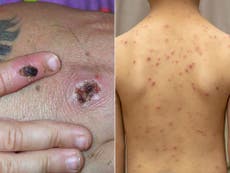 Monkeypox: How is it different from chickenpox? 