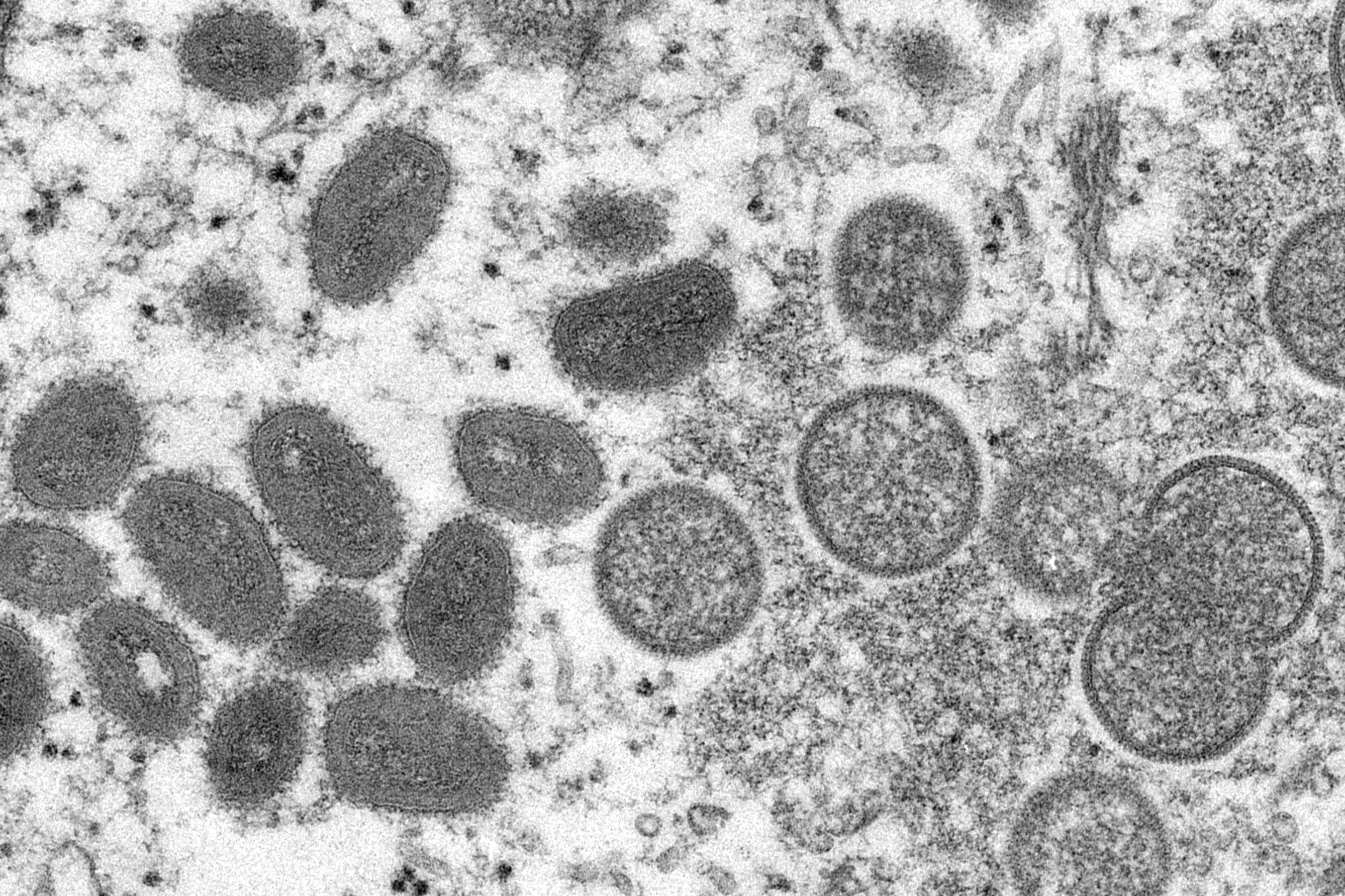 This 2003 electron microscope image made available by the Centers for Disease Control and Prevention shows monkeypox developing in a patient