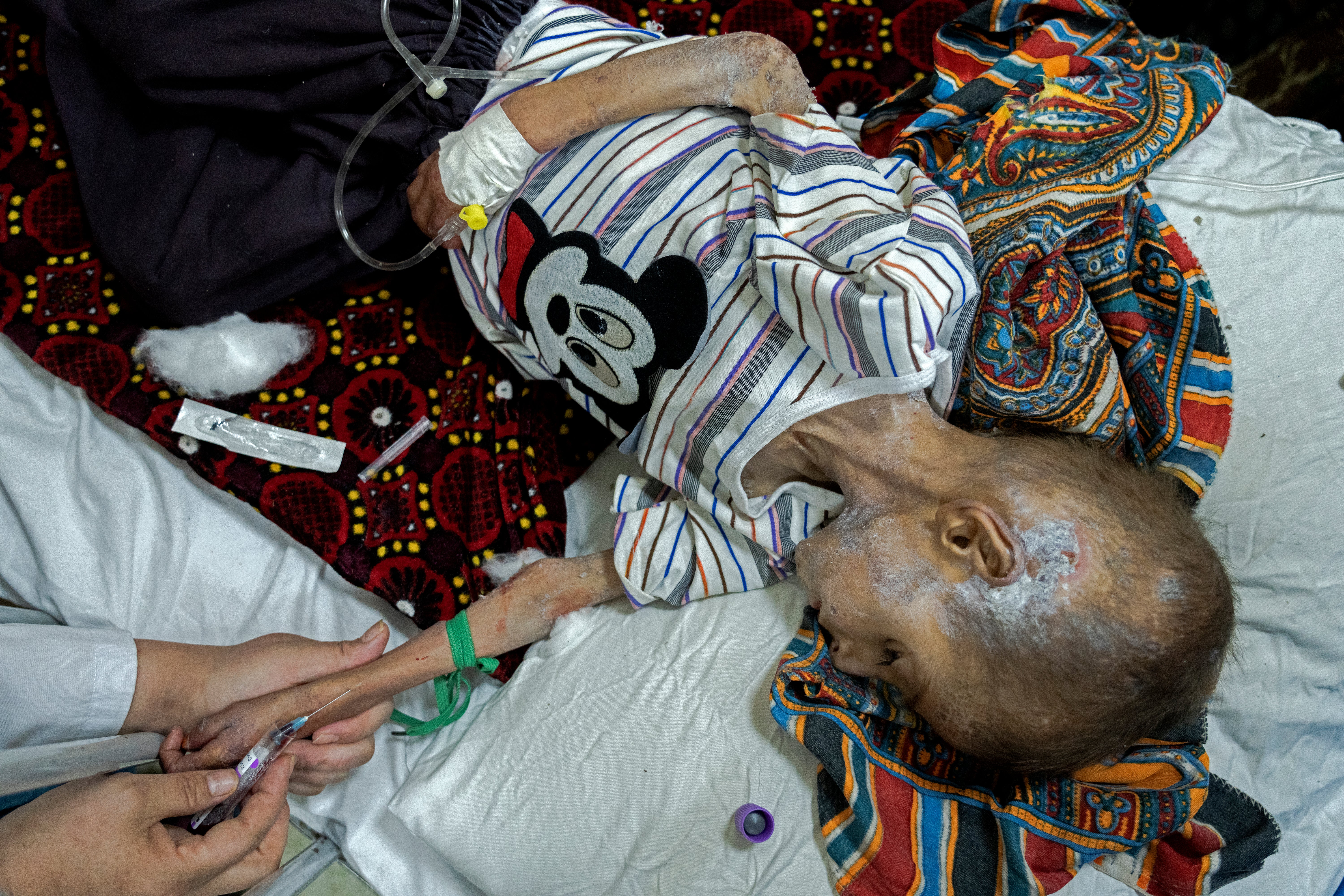 An acute malnourished boy is treated at the Indira Gandhi hospital in Kabul, Afghanistan