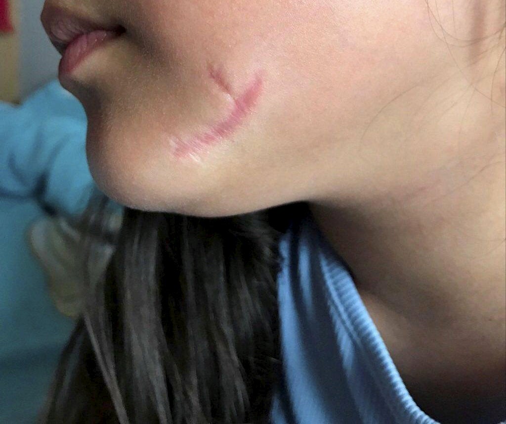 The healed wound that has left a scar on the victim's face