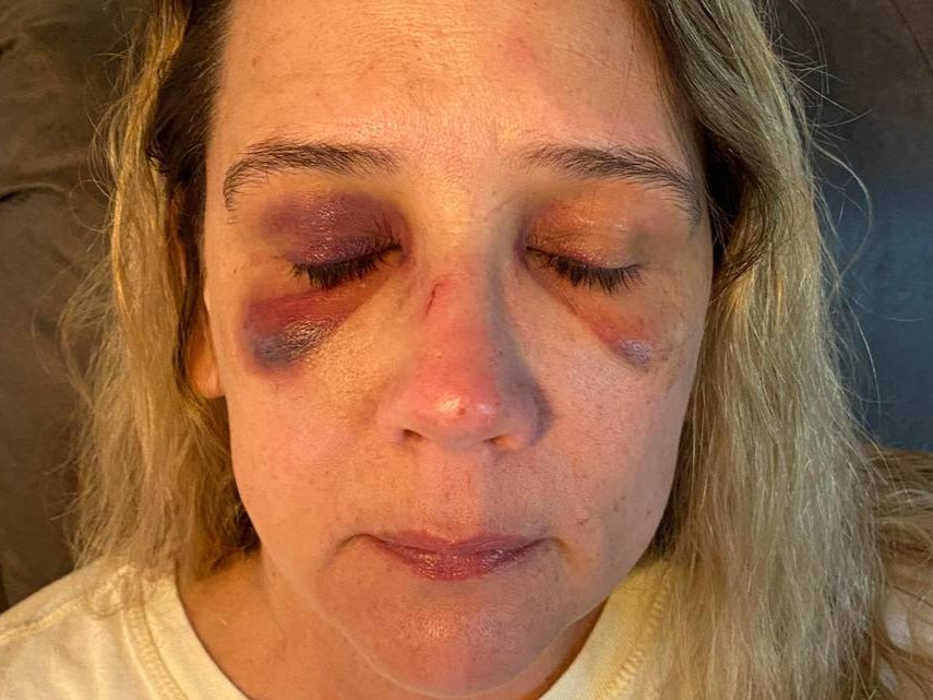 Michelle Audo pictured two days after being beaten by teens who wanted to fight her daughter