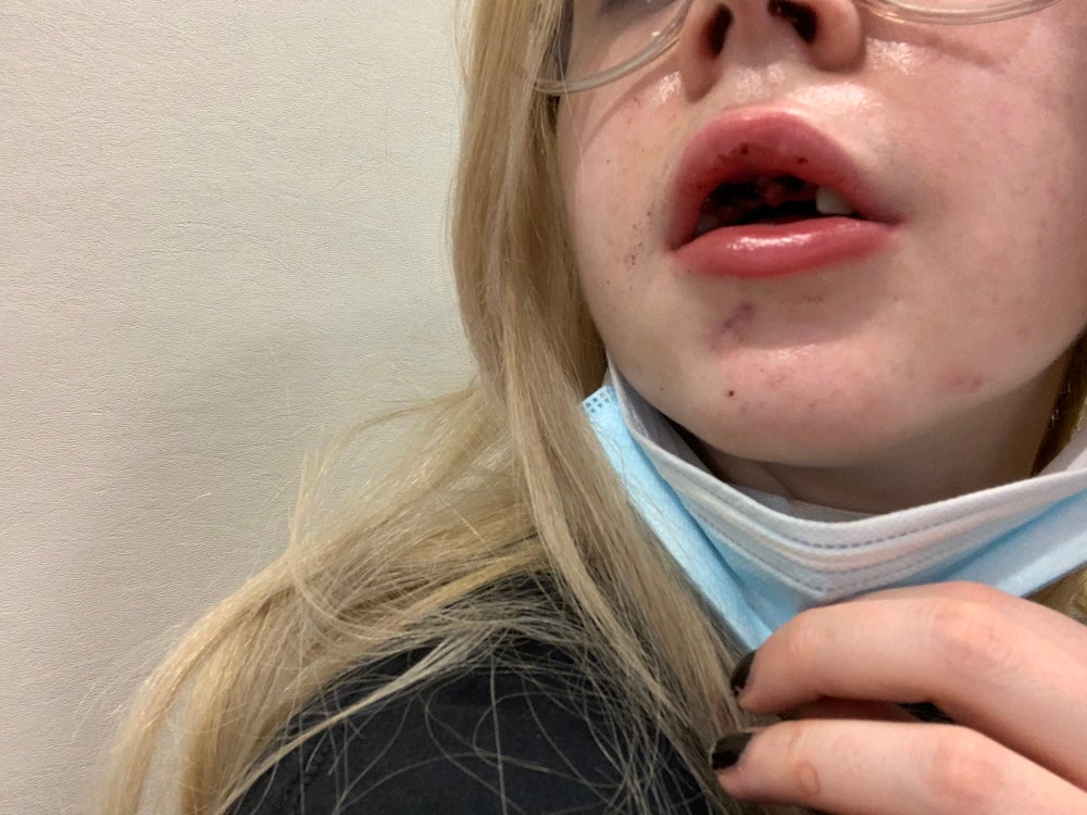 Georgina with her swollen lip (Collect/PA Real Life)