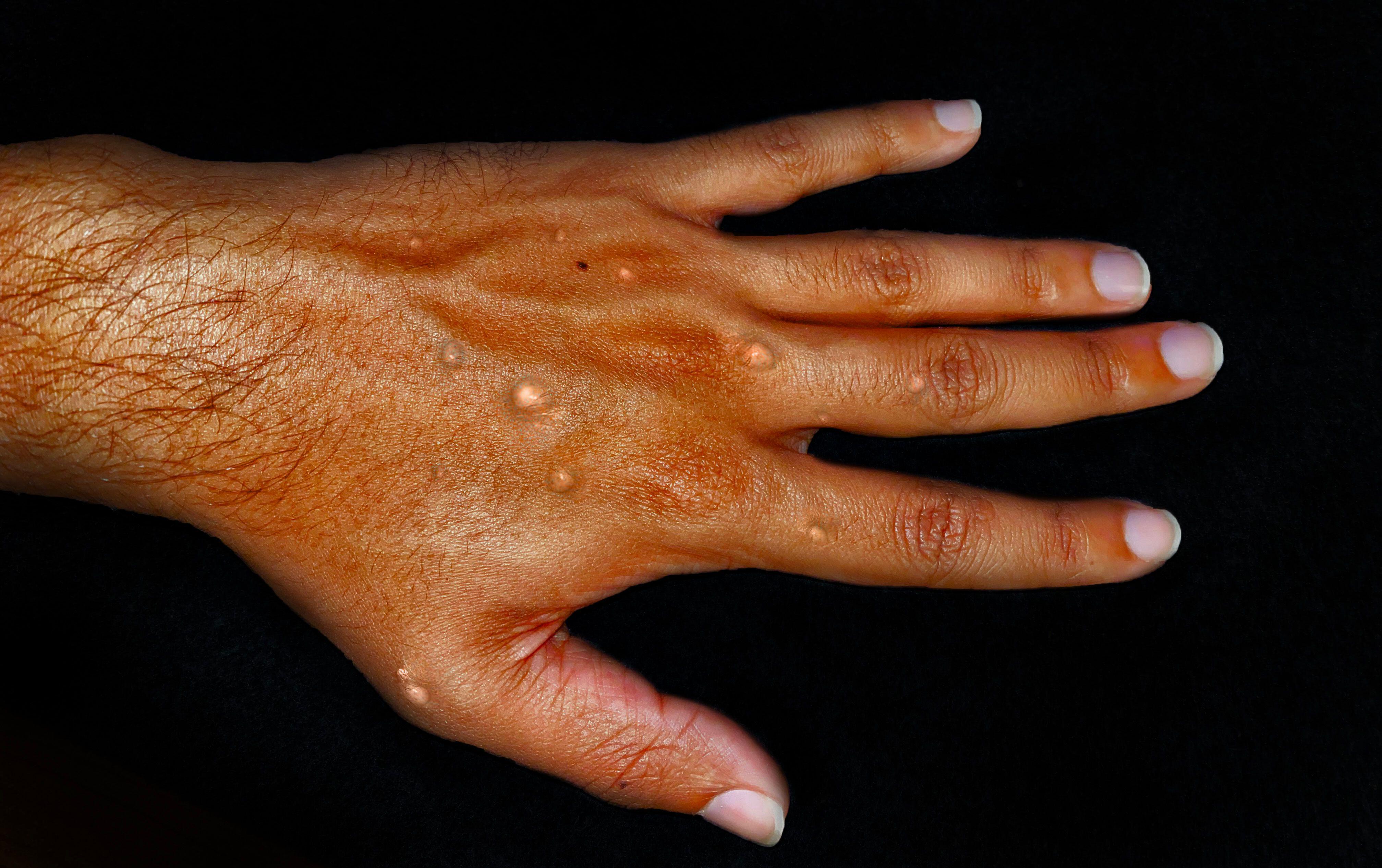 Monkeypox cases are continuing to spread in the UK (Alamy/PA)