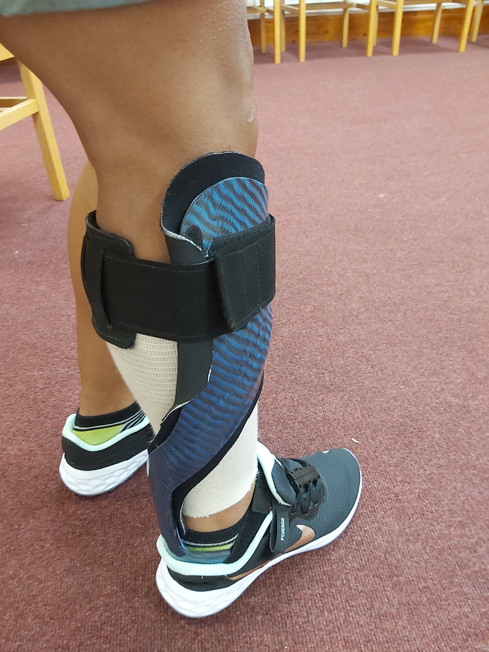 Nina wears an ankle foot orthosis brace to hold her foot up and prevent ‘drop foot’ (Collect/PA Real Life)