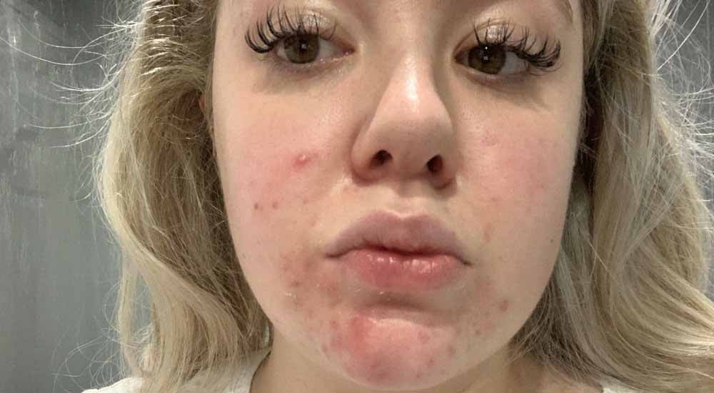 Emma says her acne affected her confidence. (Collect/PA Real Life)