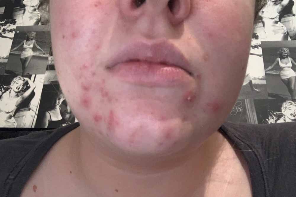 Emma first got acne at 14 years old. (Collect/PA Real Life)