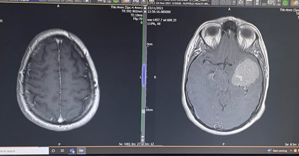 Anna Kane’s brain scans after surgery (left) and before surgery (right) (Collect/PA Real Life)