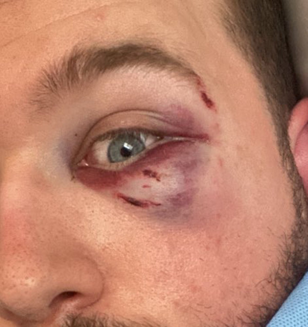 Evan Somers was left with a fractured eye socket after the attack