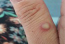 ‘January 2020 all over again’: Doctors warn Biden’s lack of urgency on Monkeypox is like early delays with Covid