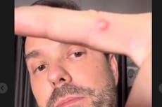 Fashion blogger who caught monkeypox describes what it’s like to have virus