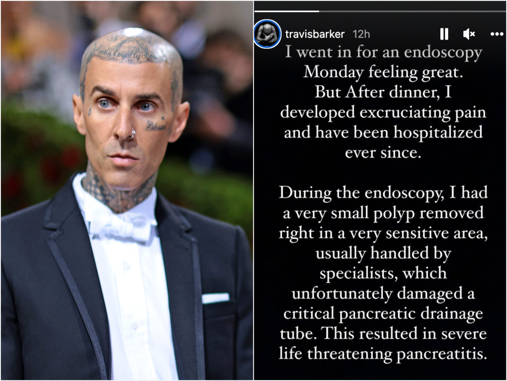 Travis Barker diagnosed with ‘life-threatening pancreatitis’ as he shares health update 