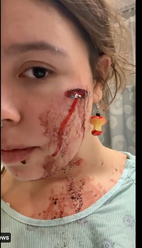 Lilli shared graphic images of her injuries after she was shot during the Highland Park 4th of July parade