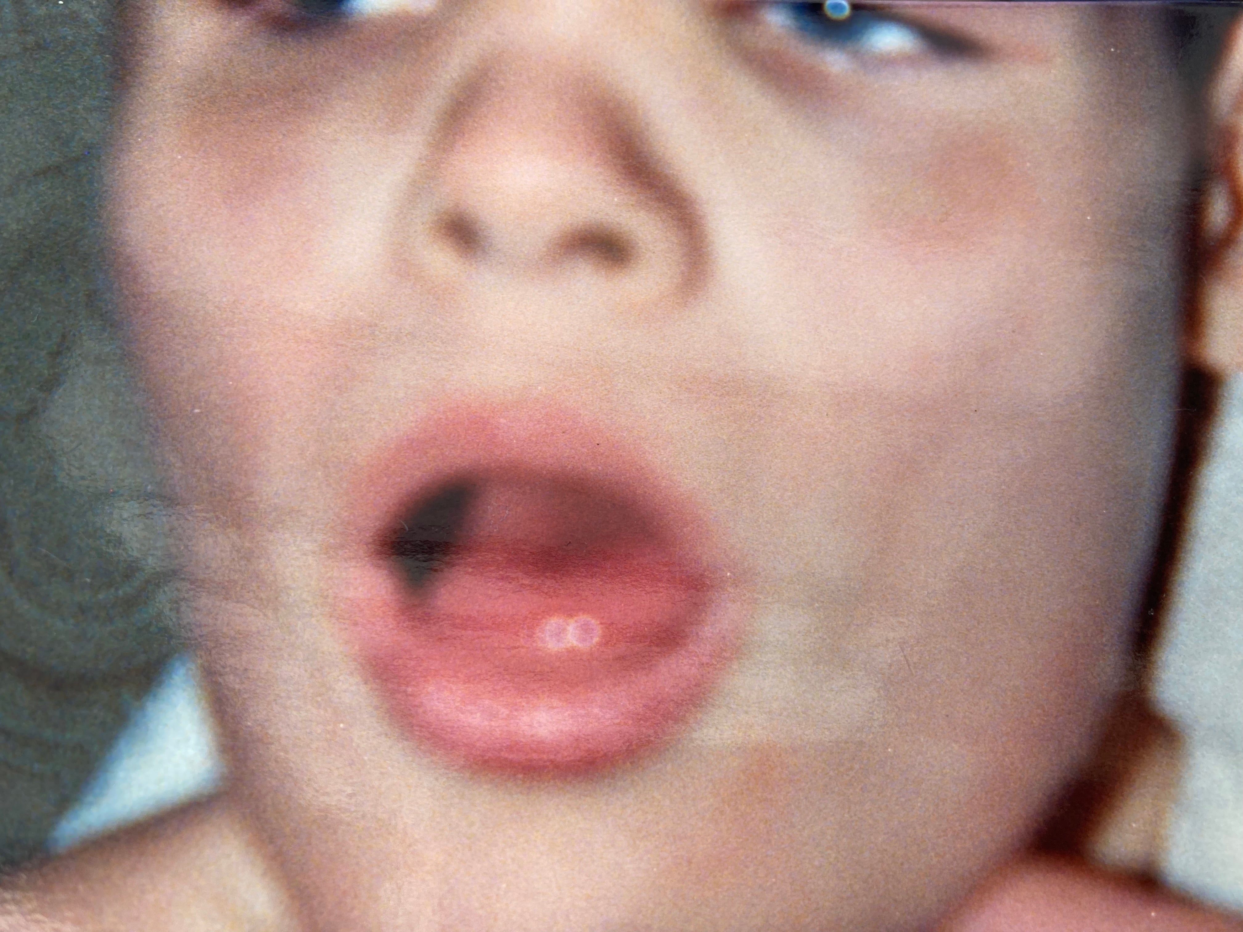 Michael Overend as a 10-year-old in 1990 with injuries after arriving home from Muckamore Abbey Hospital in Co Antrim (Overend family/PA)