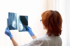 Low risk of overdiagnosis linked to breast cancer screening – study