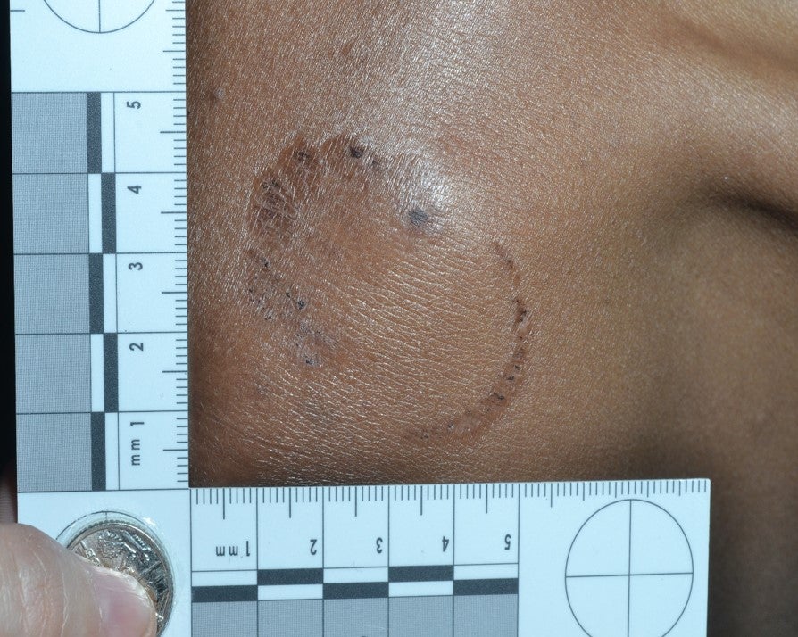 The bite mark on Adhnon Marrtab’s shoulder matched his victim’s description