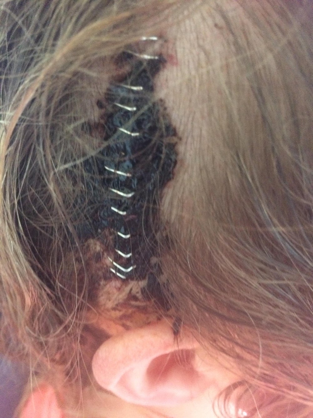 Anneka after surgery (Collect/PA Real Life)