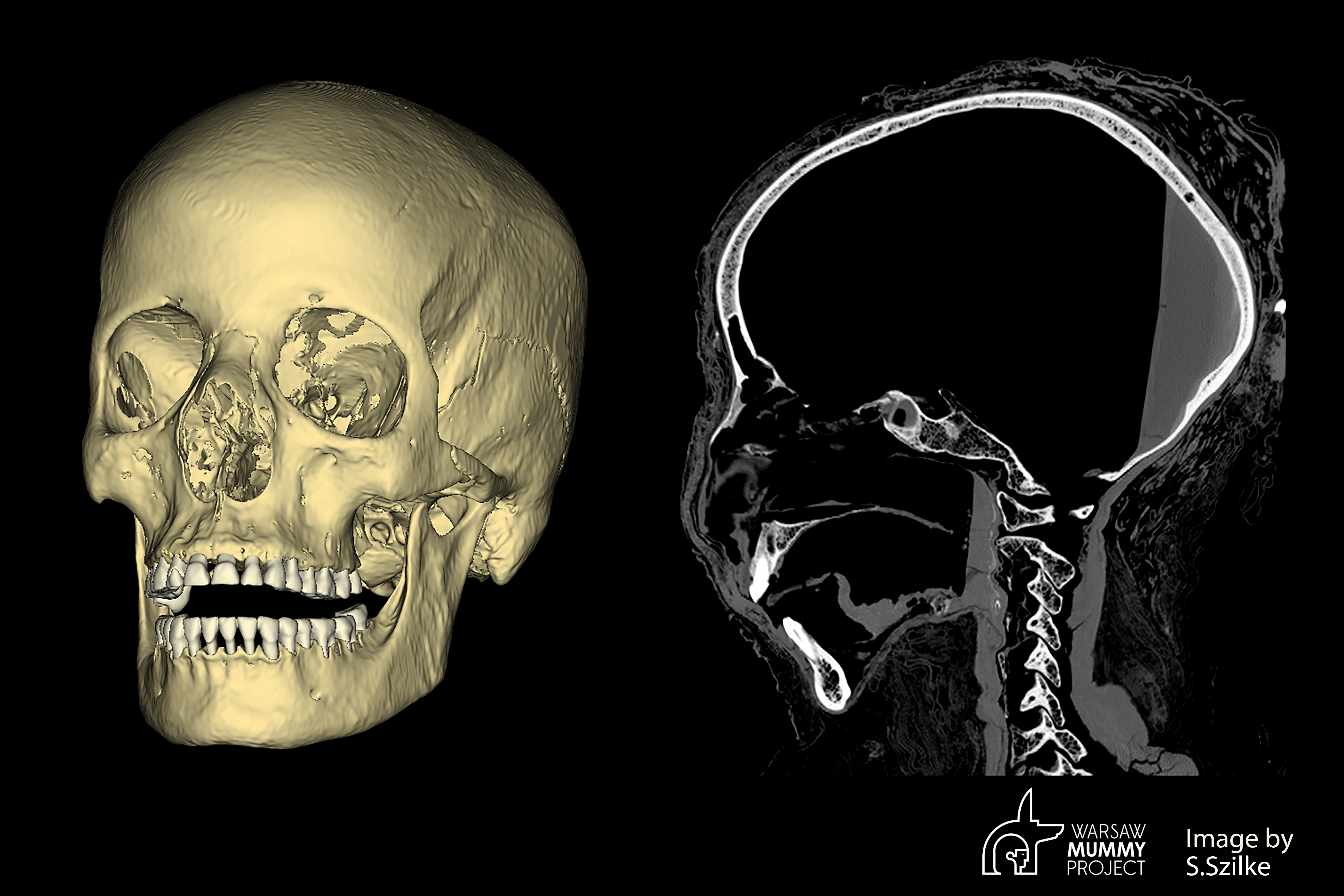 The mysterious pregnant mummy skull