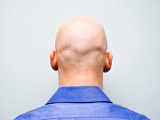 Scientists find potential ‘cure’ for baldness 