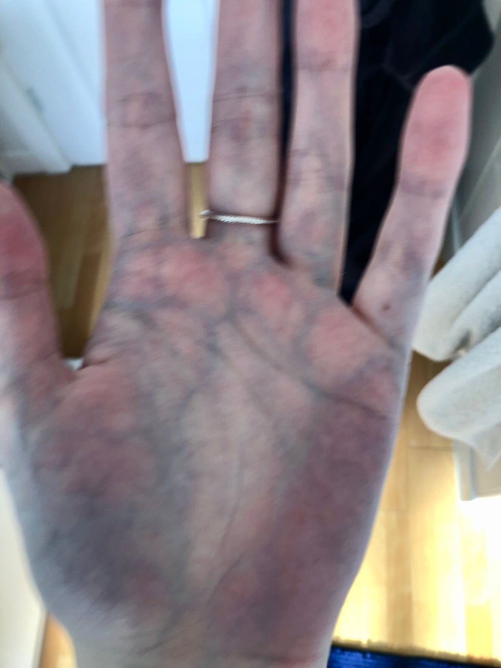 Katherine Francis, 29, said she often has blue hands because of her poor circulation (Collect/PA Real Life)