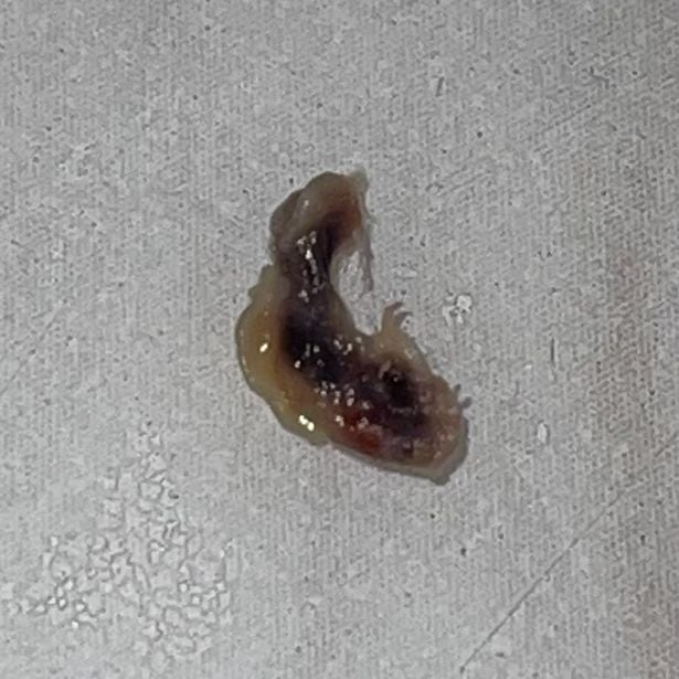 The ‘parasite’ that came out of Louise’s eyelid