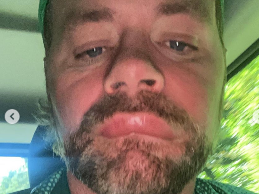 Brian McFadden shared the allergic reaction he suffered after a bee stung his face