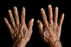 Does gene therapy provide an answer to ageing?