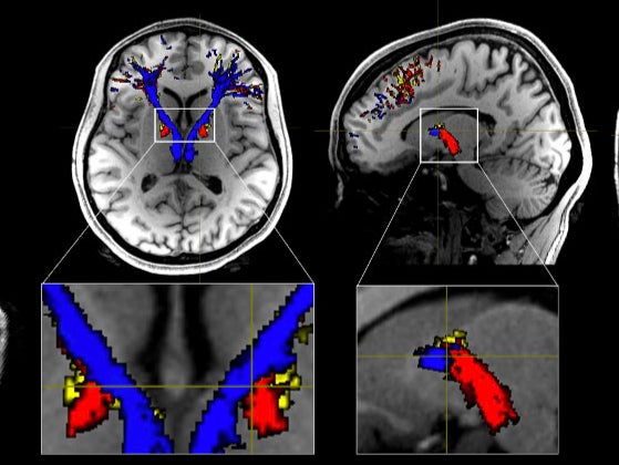 Addicts’ brains contain less white matter than people who do not consume the class A substances, say experts