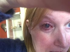 Woman loses eye after it became infected while she was having a shower 