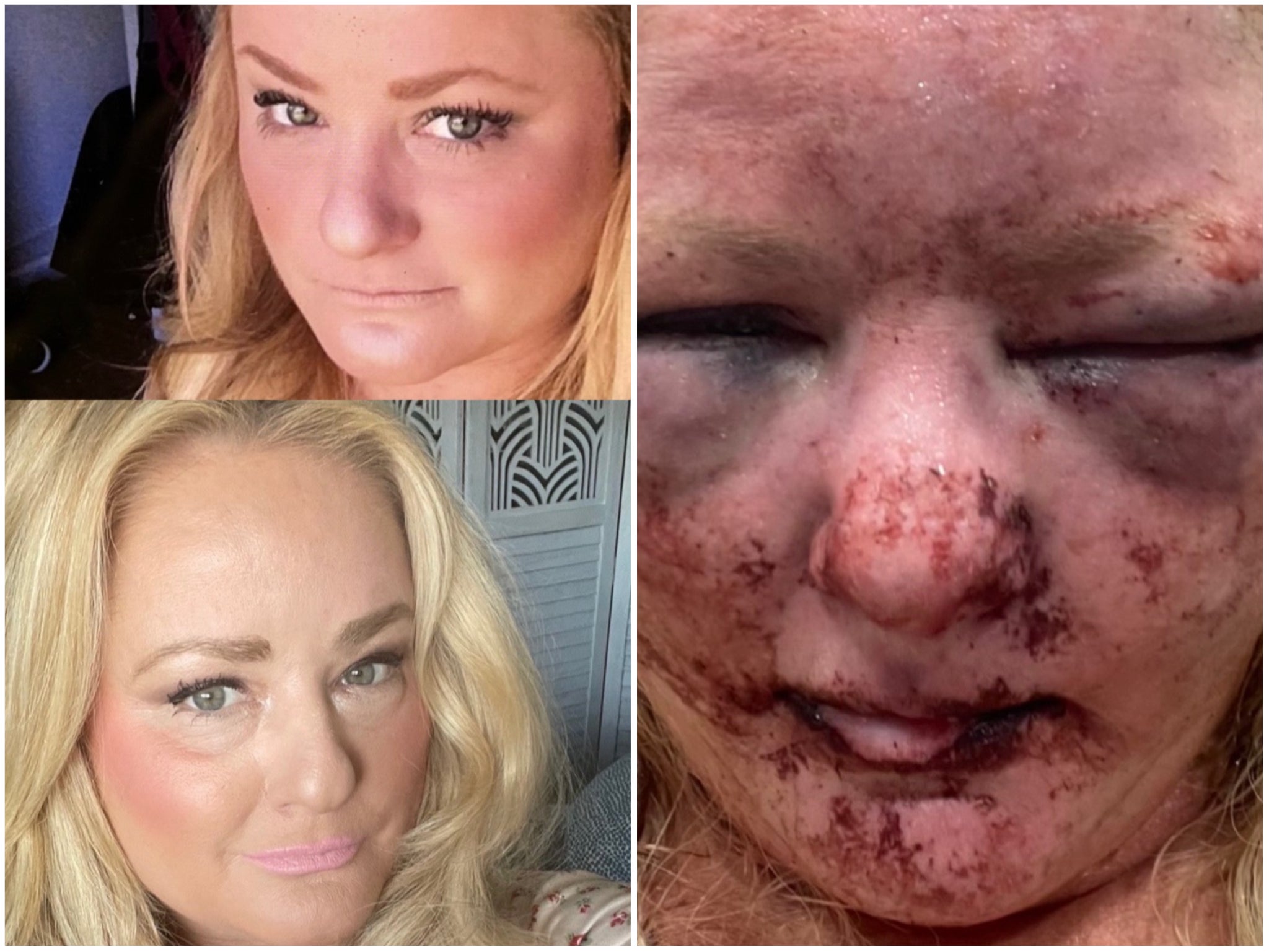 Marissa Young shared an image of herself after being attacked by a homeless man