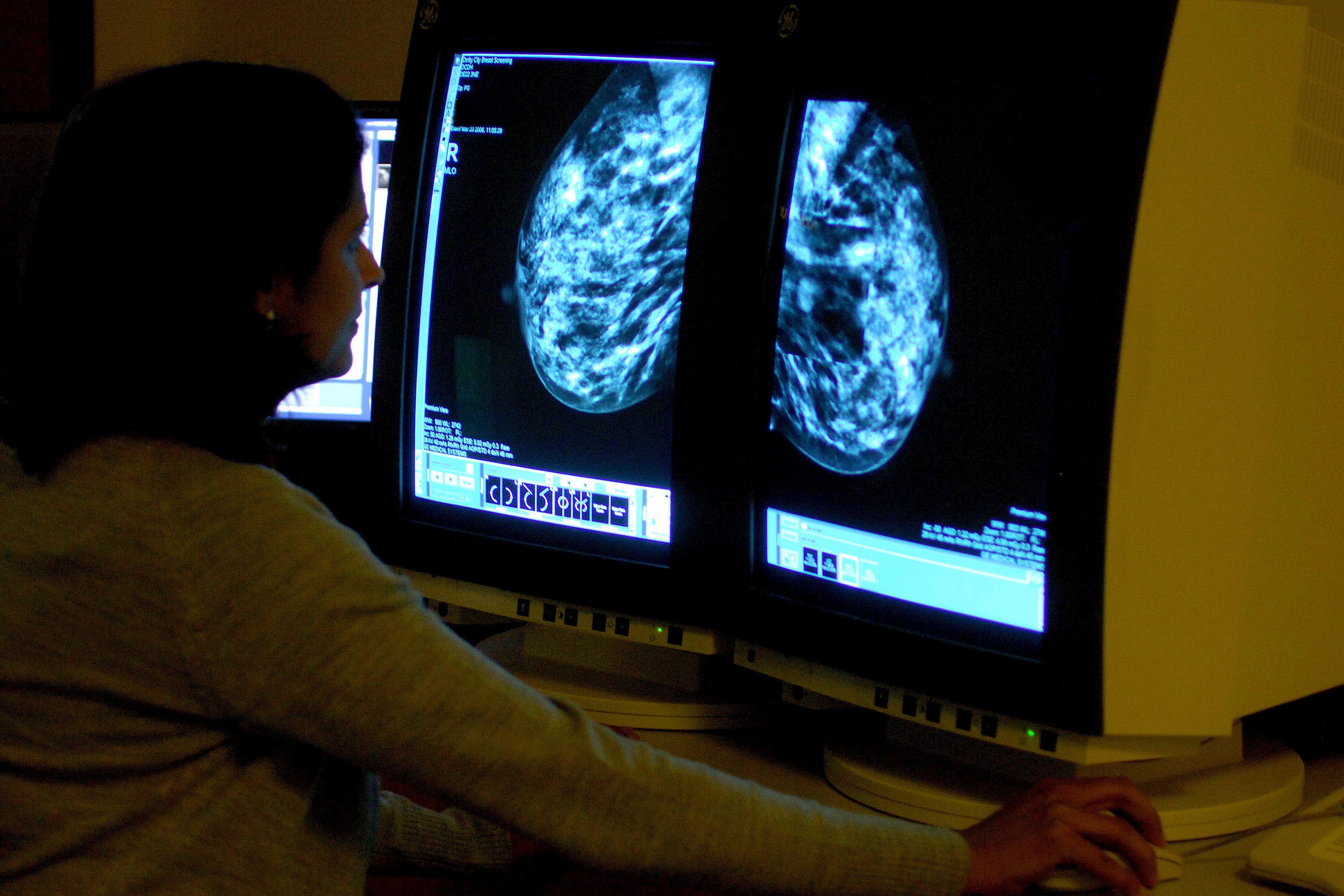 New drug for triple negative breast cancer approved for NHS use