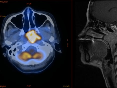 Tumours, highlighted in yellow, shrank more in vaccinated people