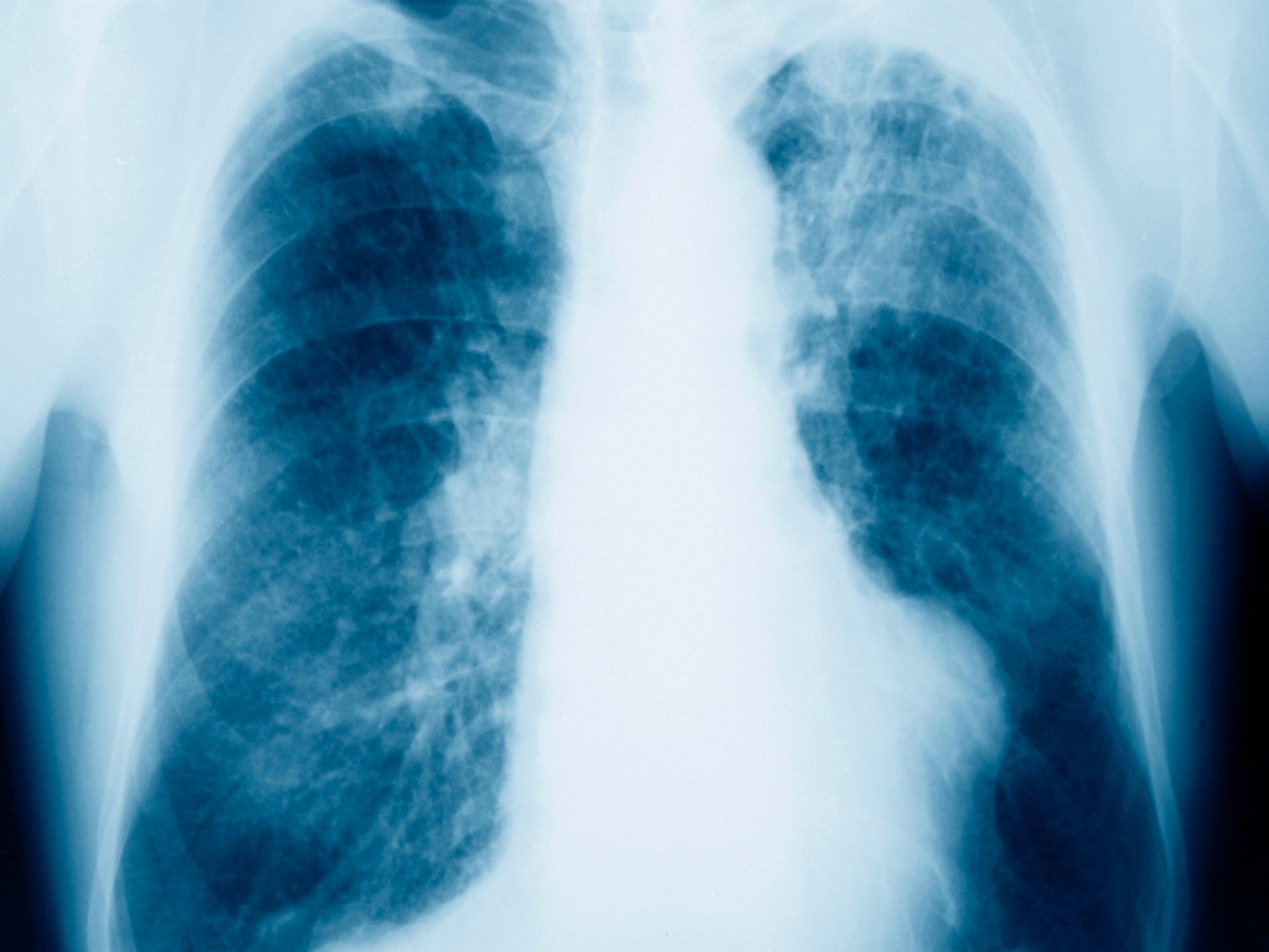 A chest X-ray of a male patient showing evidence of mesothelioma