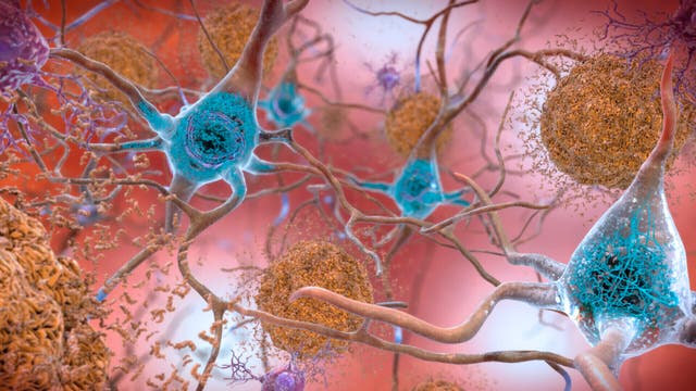 <p>Lecanemab is shown to slow the progression of Alzheimer’s disease</p>