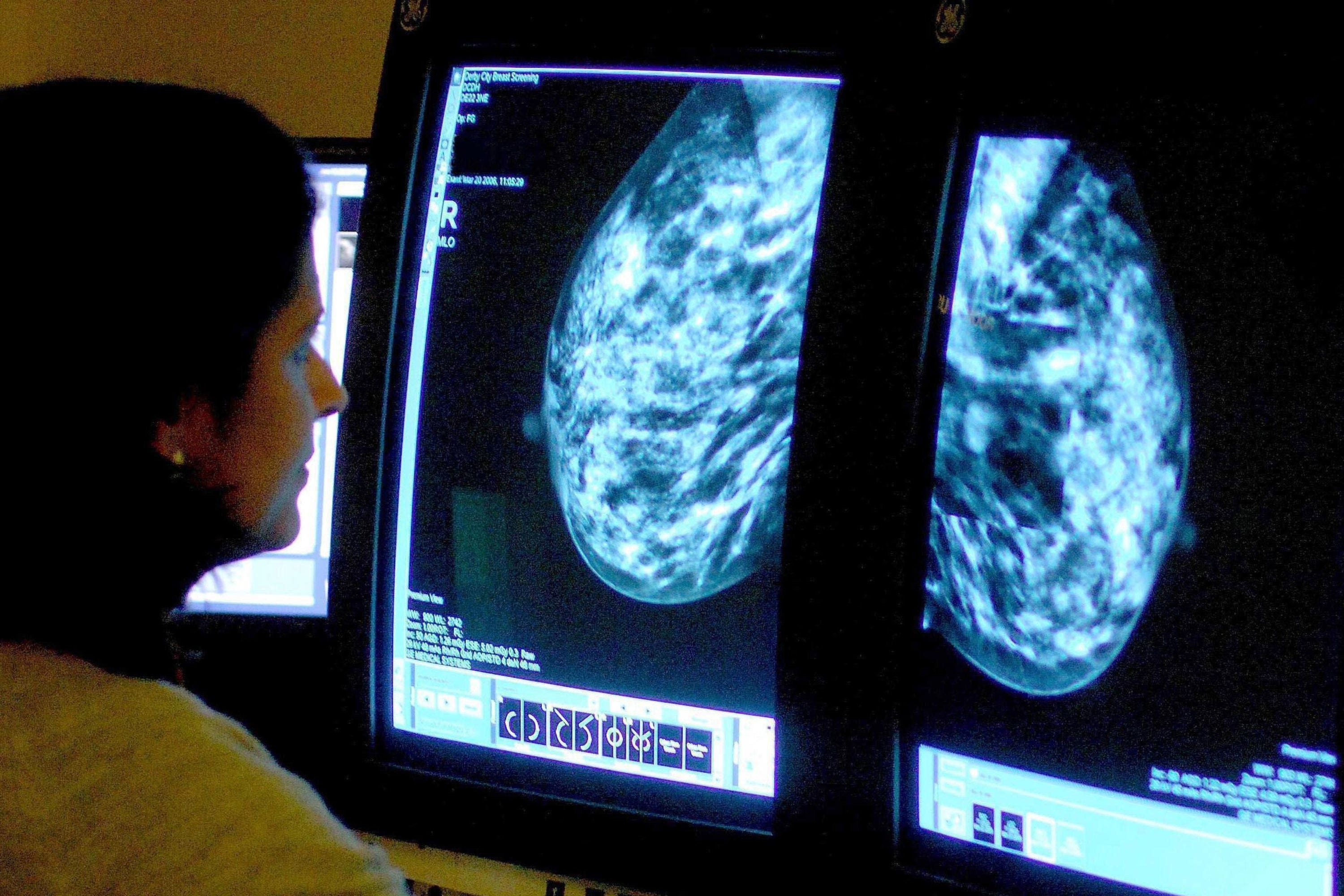 A radiação radioterapia usa a morte de células cancerígenas e geralmente é dada após a cirurgia para reduzir o risco de retorno da doença