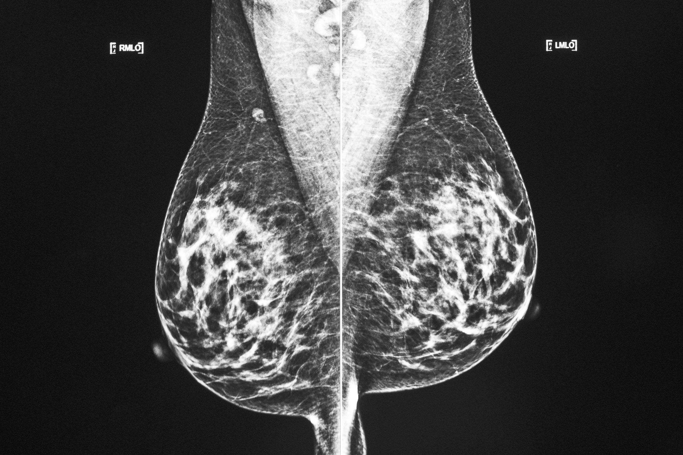 Breast Cancer Surgery