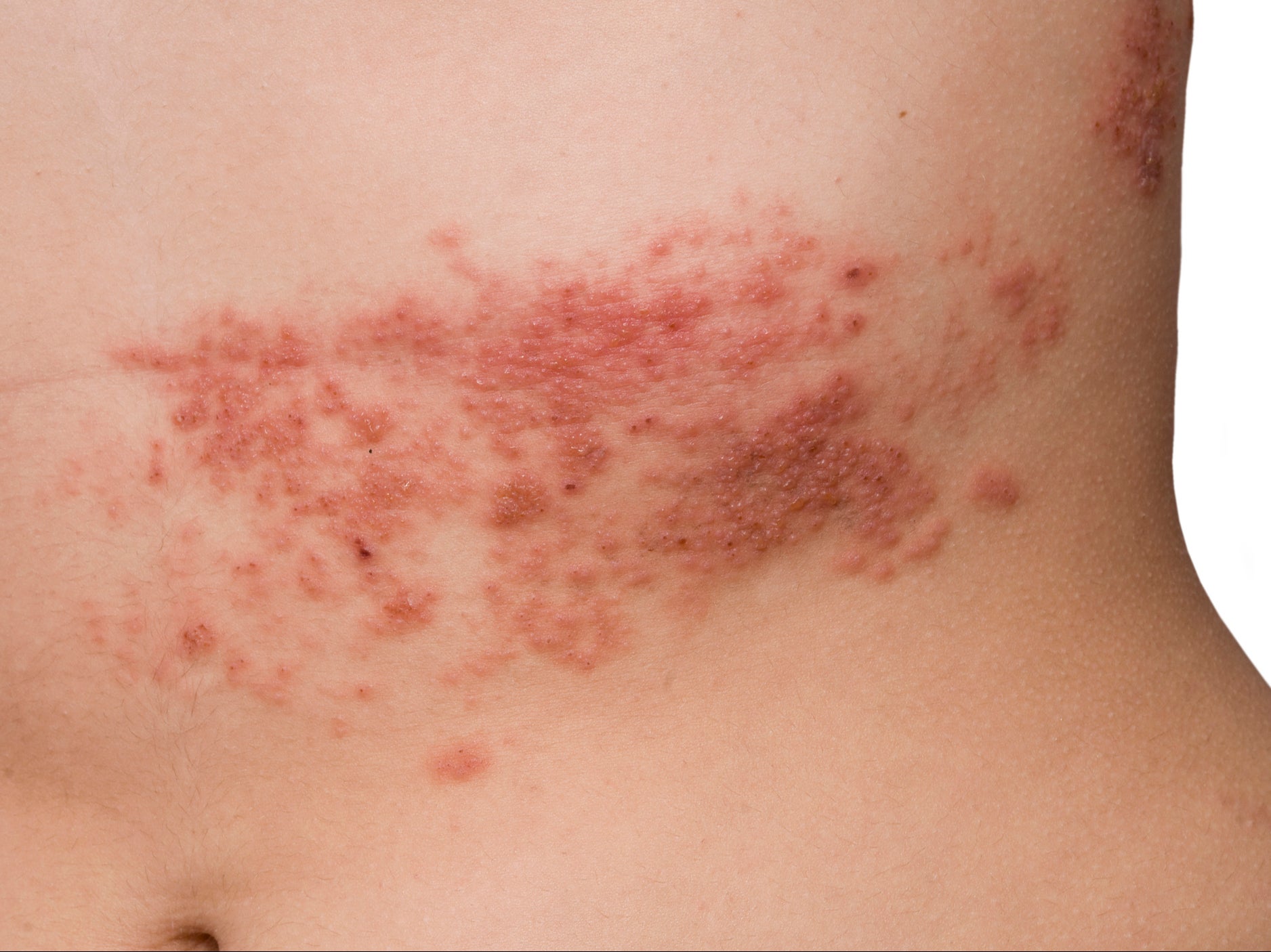 Shingles can cause a painful rash and can lead to serious problems including sight loss, hearing problems and scarring